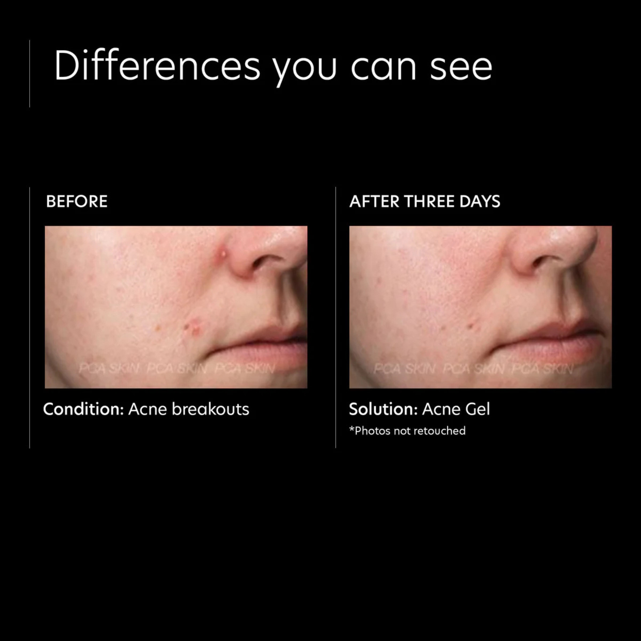 Acne Gel with Omnisome®