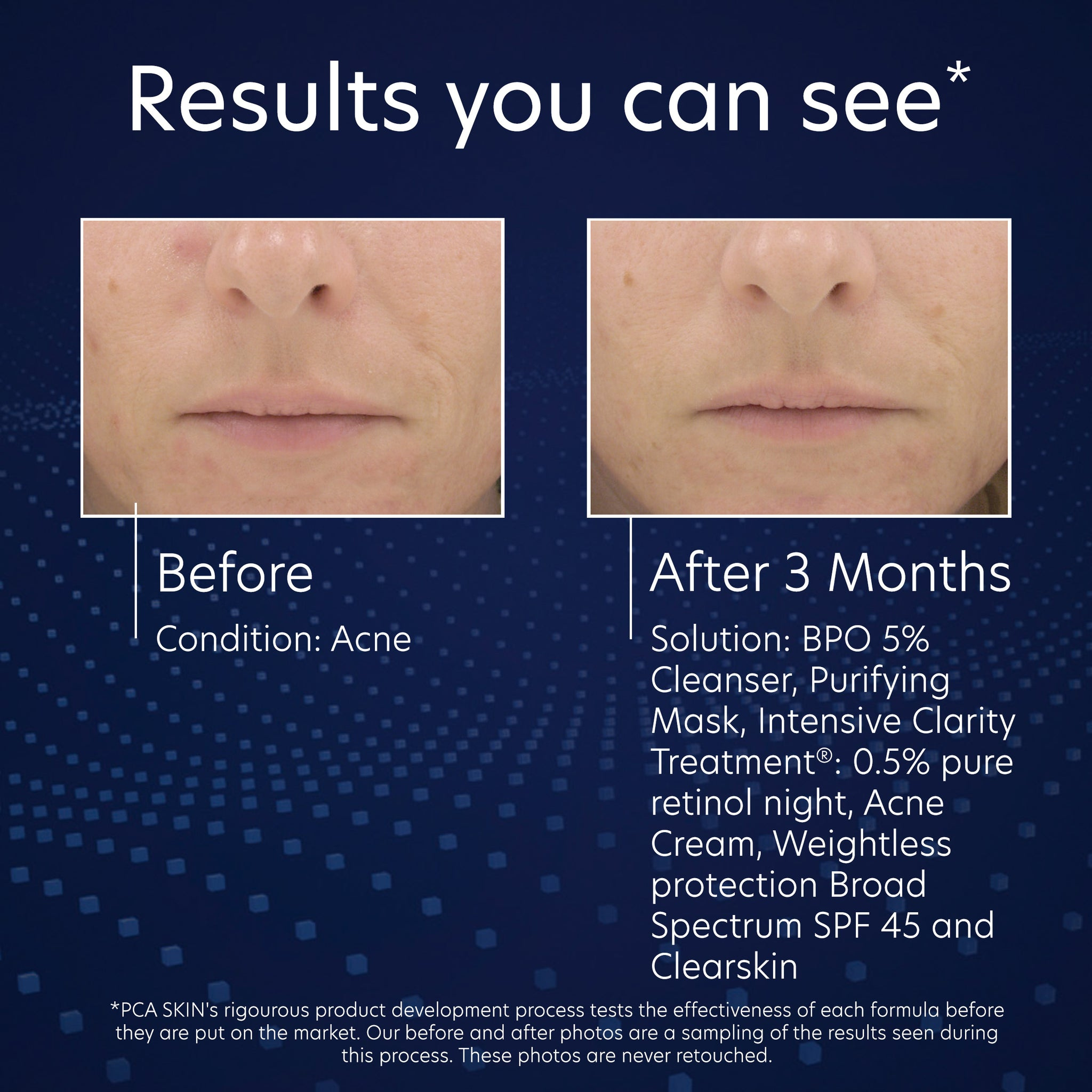 BPO 5% Cleanser